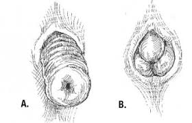 Symptoms Of Rectal Prolapse