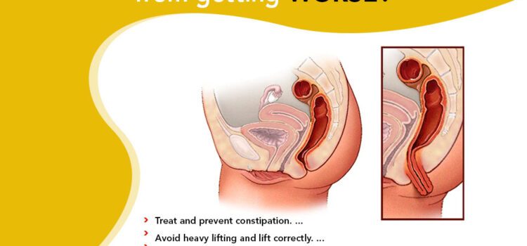 How Can I Stop My Prolapse From Getting Worse?