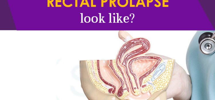 What Does Rectal Prolapse Look Like?