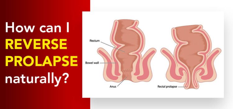 How Can I Reverse Prolapse Naturally?