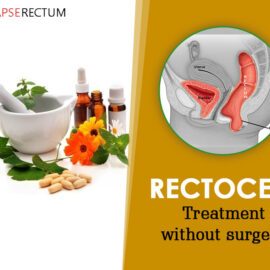 Rectocele Alternative Treatments