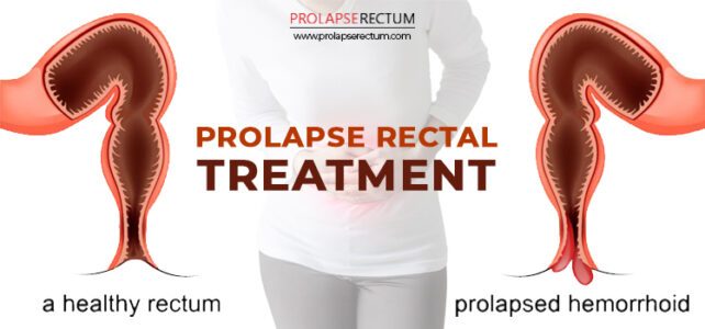Prolapse Rectal Treatment In India