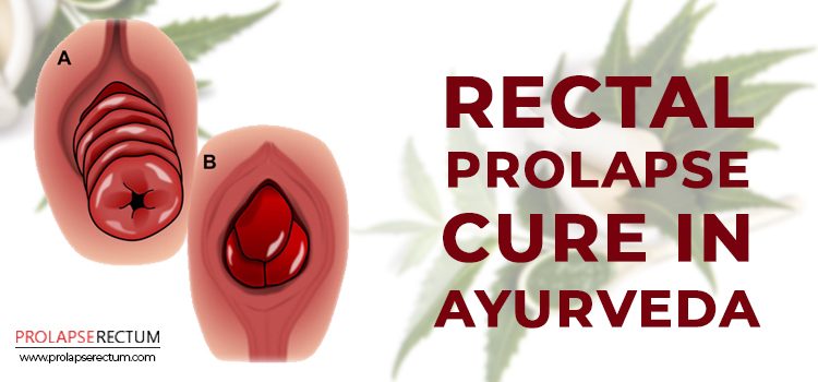 Rectal prolapse cure in ayurveda