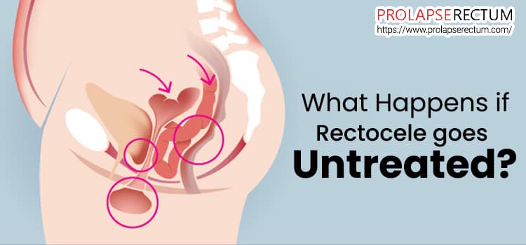 What Happens If Rectocele Goes Untreated