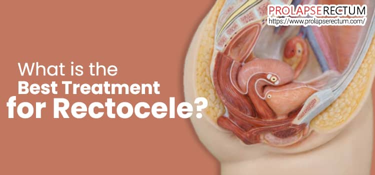 What is the best treatment for Rectocele