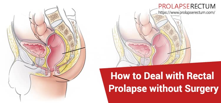 Rectal Prolapse Without Surgery