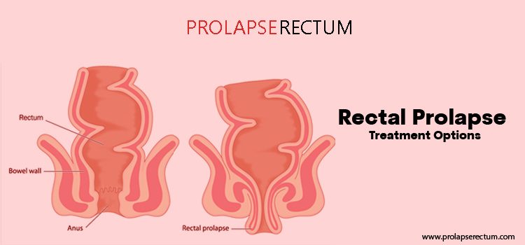 Rectal Prolapse Treatment Options