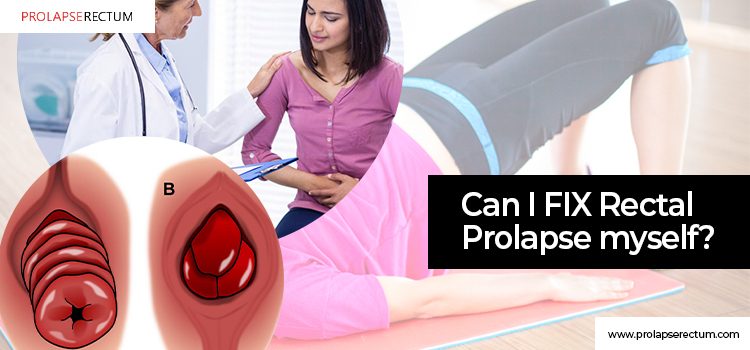 Can I Fix Rectal Prolapse Myself?