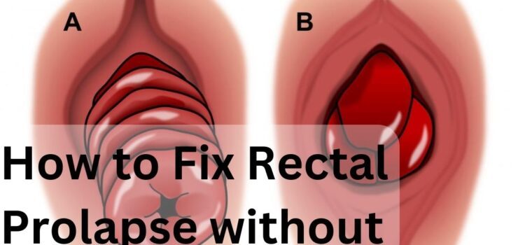 How To Fix Rectal Prolapse