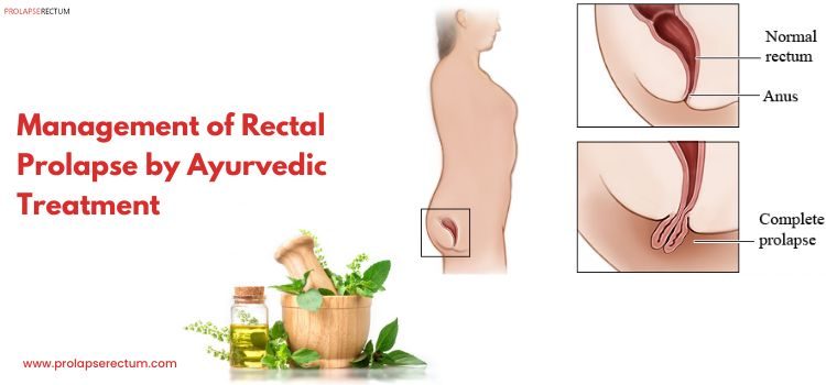 Management of Rectal Prolapse by Ayurvedic Treatment