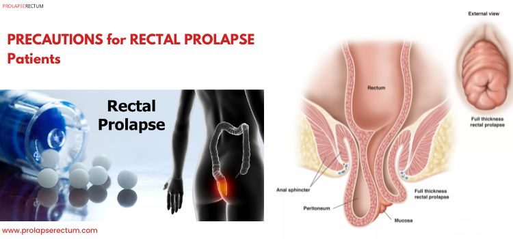 Precautions for Rectal Prolapse Patients