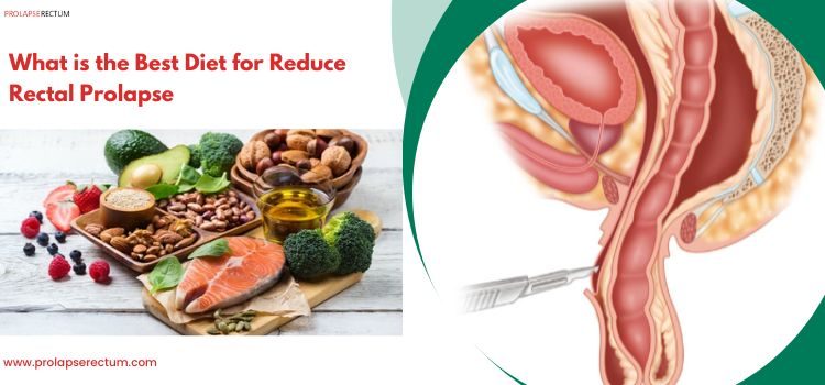 What is the Best Diet To Reduce Rectal Prolapse?