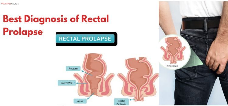 Recognizing Signs and Symptoms of Rectal Prolapse
