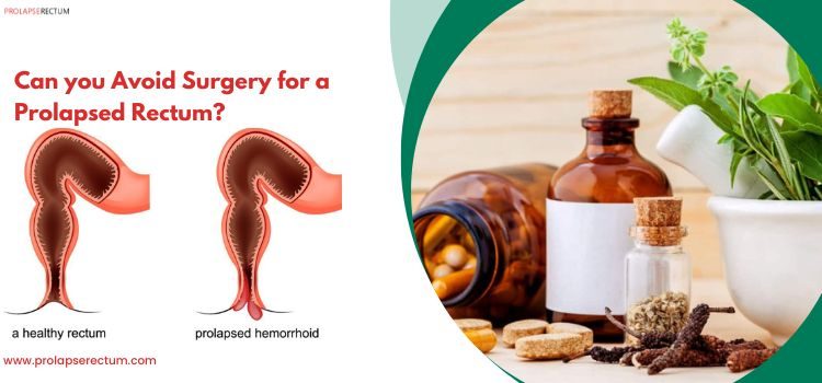 Can You Avoid Surgery for a Prolapsed Rectum?