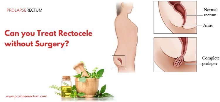 Can You Treat Rectocele Without Surgery?