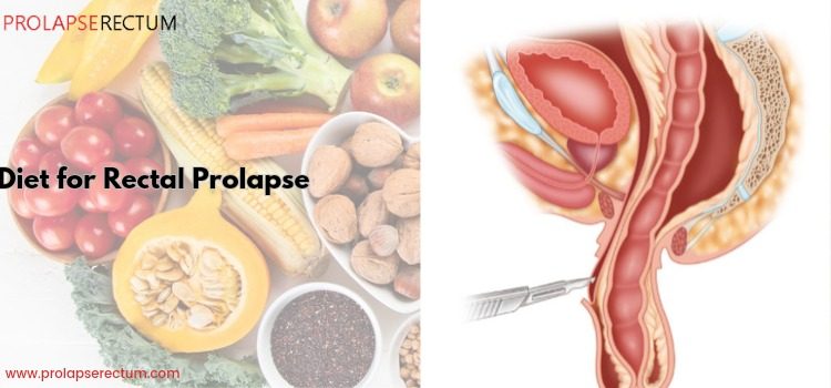 Diet for Rectal Prolapse