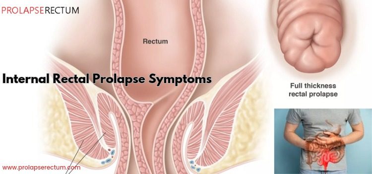 Internal Rectal Prolapse Symptoms