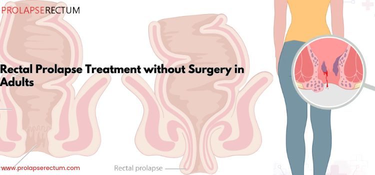 Rectal Prolapse Treatment Without Surgery in Adults