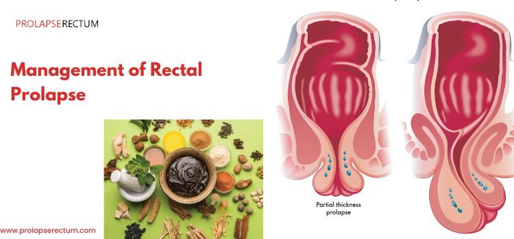 Management of Rectal Prolapse