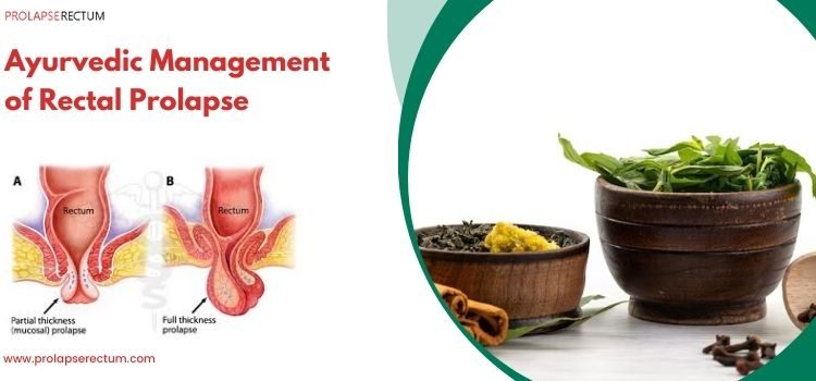 Ayurvedic Management of Rectal Prolapse